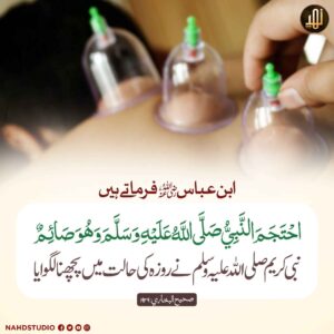 روزے کی حالت میں سینگی لگوانا